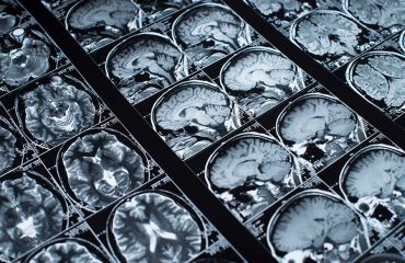 MRI brain scan images